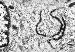  F,11y. | ependymoma